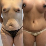 Before and after mommy makeover results – improved abdomen and breast contour
