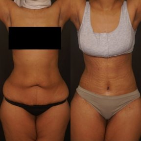 Before and after mommy makeover results – visible waist and abdomen contour improvement