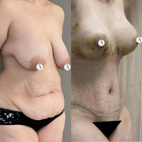 Before and after mommy makeover results – breast lift and tummy tuck visible improvement