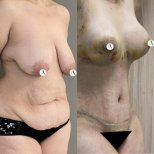 Before and after mommy makeover results – breast lift and tummy tuck visible improvement