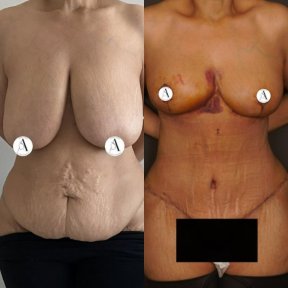 Mommy makeover before and after results – breast lift and tummy tuck visible improvement
