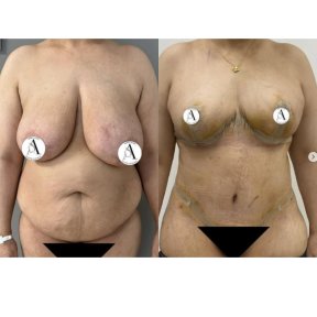 Before and after mommy makeover results – body contouring and breast lift transformation