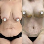 Before and after mommy makeover results – breast lift and tummy tuck visible improvement