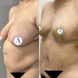 Mommy makeover before and after results – breast lift and tummy tuck visible improvement