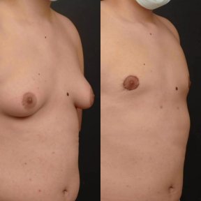 before-after photo gynecomastia-surgery