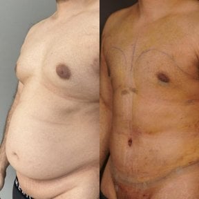 before-after photo gynecomastia-surgery
