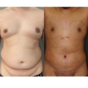 before-after photo gynecomastia-surgery