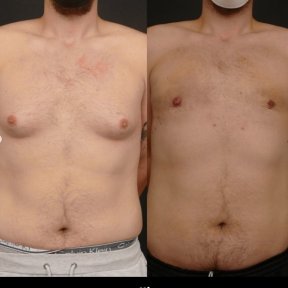before-after photo gynecomastia-surgery