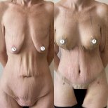 Résultats avant/après chirurgie plastique post-bariatrique – silhouette et peau raffermies