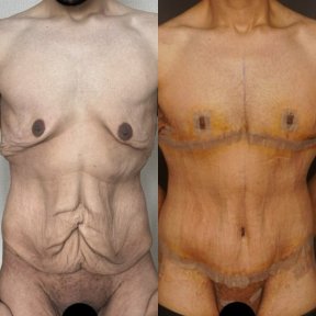 Résultats avant/après chirurgie plastique post-bariatrique – retrait peau et remodelage corporel