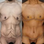 Résultats avant/après chirurgie plastique post-bariatrique – retrait peau et remodelage corporel