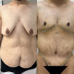 Résultats avant/après chirurgie post-bariatrique – contour poitrine et abdomen amélioré