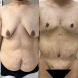 Résultats avant/après chirurgie post-bariatrique – contour poitrine et abdomen amélioré