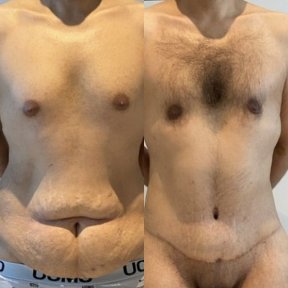 Before and after tummy tuck results in male patient – improved abdominal contour
