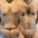Before and after tummy tuck results in male patient – improved abdominal contour