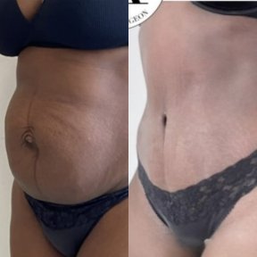 Before and after tummy tuck results – flatter abdomen and improved contour after abdominoplasty