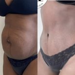 Before and after tummy tuck results – flatter abdomen and improved contour after abdominoplasty