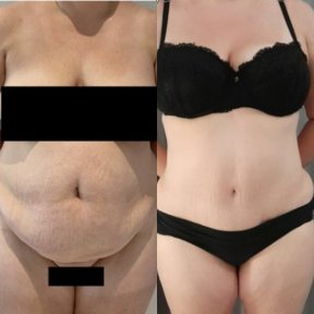 Before and after tummy tuck results – visible abdominal contour improvement after surgery