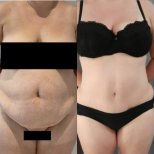 Before and after tummy tuck results – visible abdominal contour improvement after surgery