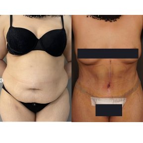 Before and after tummy tuck results – visible abdominal contour improvement after surgery