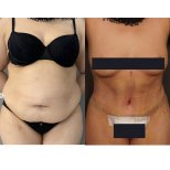 Before and after tummy tuck results – visible abdominal contour improvement after surgery