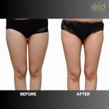 Résultats avant et après liposuccion à ID Clinic Bangkok, amélioration du contour des cuisses