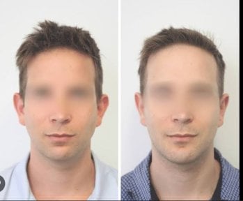 before-after photo chin-implants