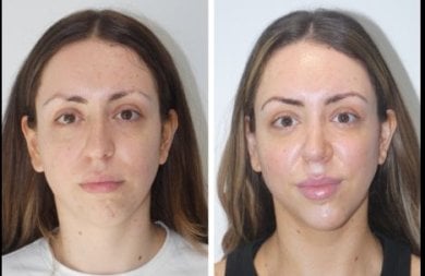 before-after photo chin-implants
