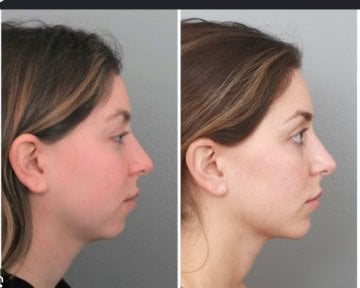 before-after photo chin-implants