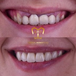 Before and after veneers at Dentaland Premium Luxury Clinic & Academy, smile makeover result