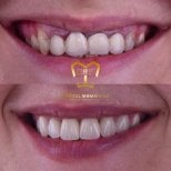 Before and after veneers at Dentaland Premium Luxury Clinic & Academy, smile makeover result