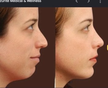 before-after photo chin-implants