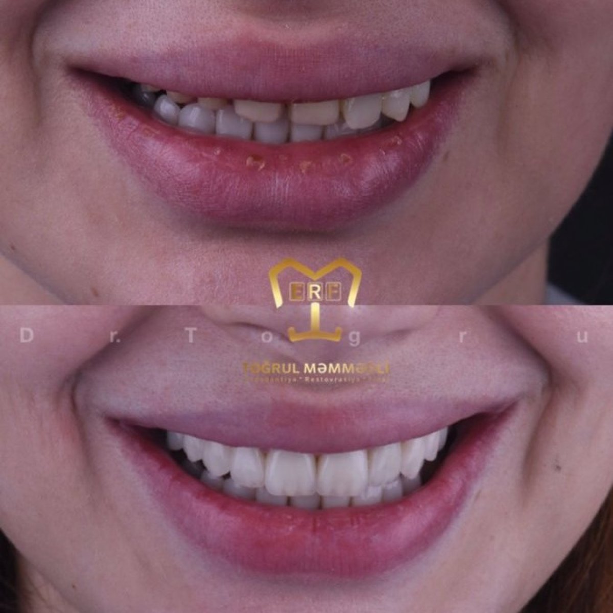 Resultado antes y después de carillas en Dentaland Premium Luxury Clinic & Academy, cambio de sonrisa