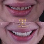 Before and after veneers result at Dentaland Premium Luxury Clinic & Academy, smile makeover