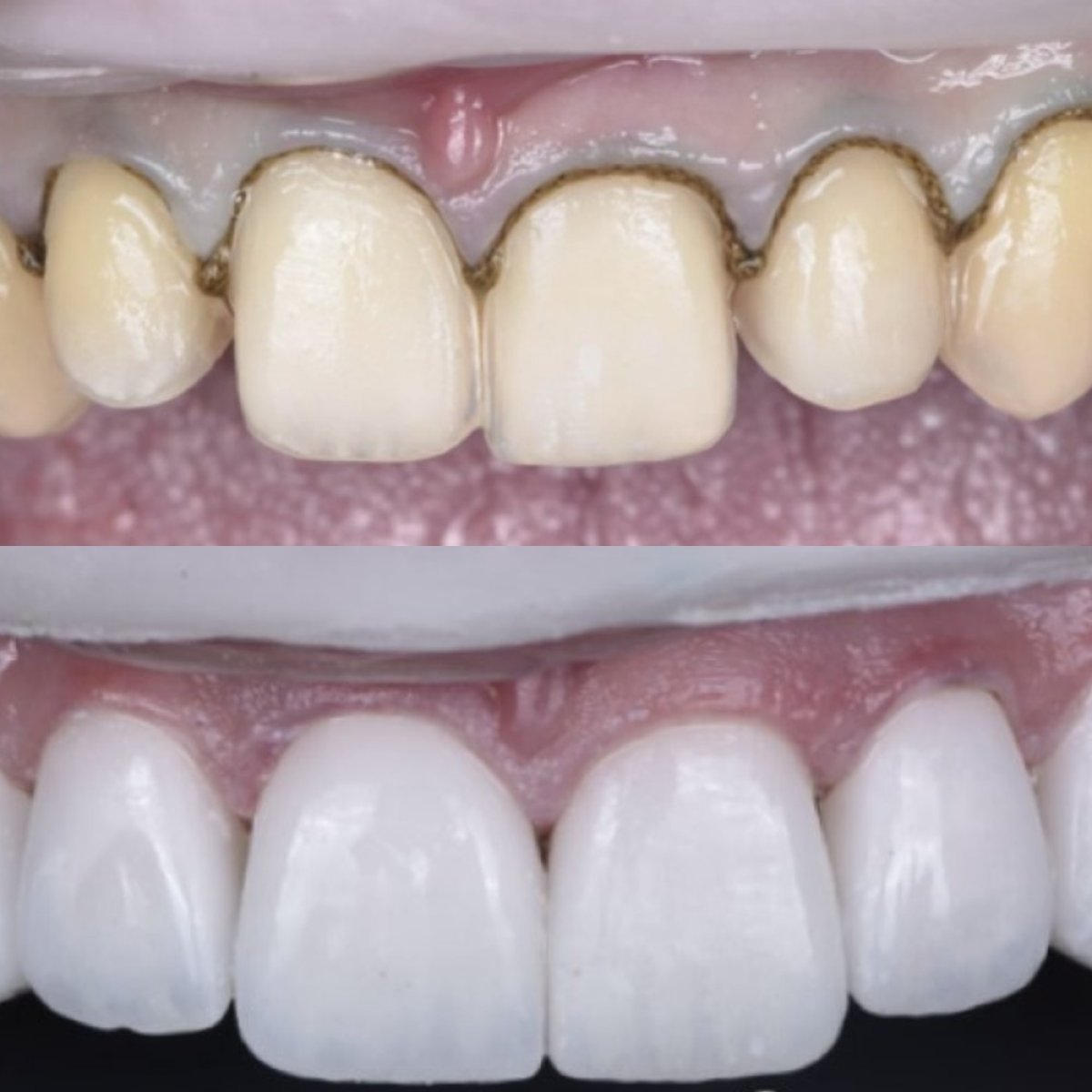 نتيجة قبل وبعد الفينير في Dentaland Premium Luxury Clinic & Academy، تجميل الابتسامة