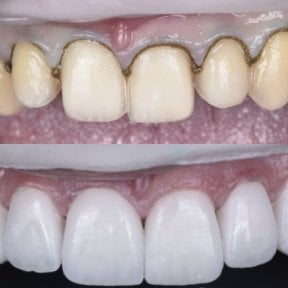 Before and after veneers result at Dentaland Premium Luxury Clinic & Academy, smile makeover