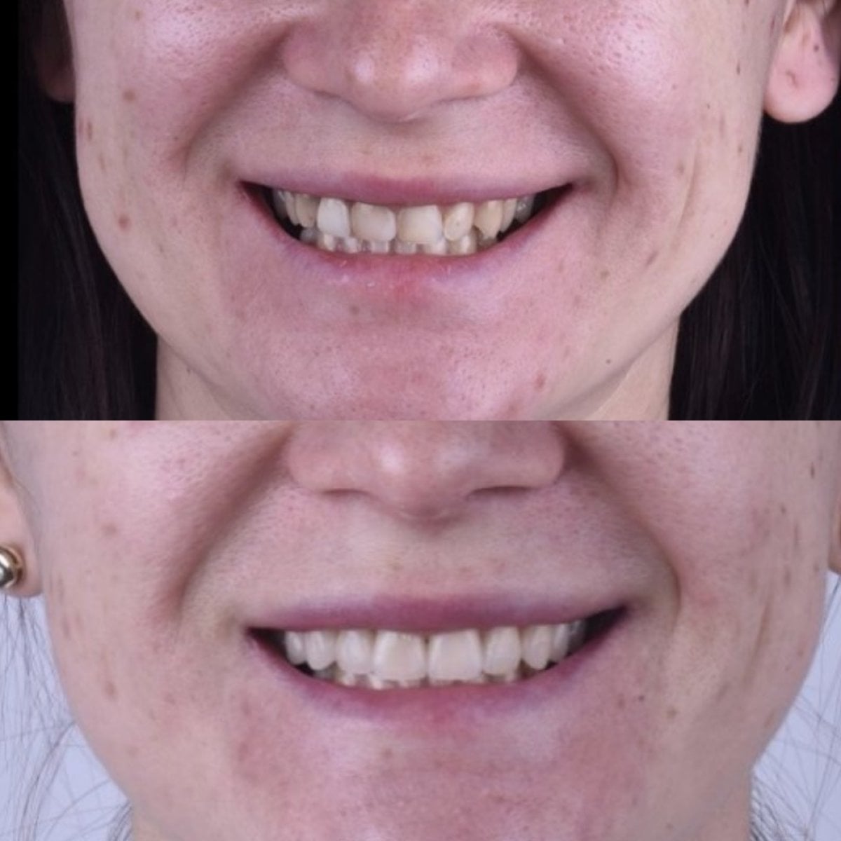 نتيجة قبل وبعد الفينير في Dentaland Premium Luxury Clinic & Academy، تجميل الابتسامة