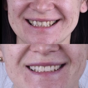 Before and after veneers result at Dentaland Premium Luxury Clinic & Academy, smile makeover