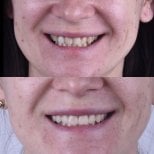 Before and after veneers result at Dentaland Premium Luxury Clinic & Academy, smile makeover