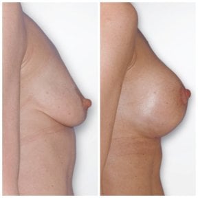 before-after photo breast-augmentation