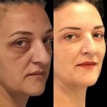 Resultados de lifting de frente antes y después en Turan Turan Health Group, aspecto juvenil