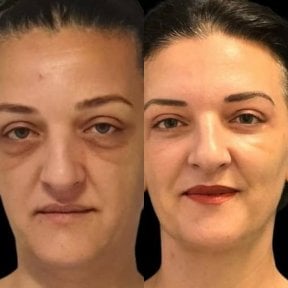 Resultados de lifting de frente antes y después en Turan Turan Health Group, rejuvenecimiento visible