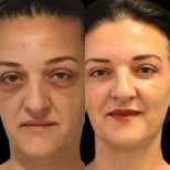 Resultados de lifting de frente antes y después en Turan Turan Health Group, rejuvenecimiento visible