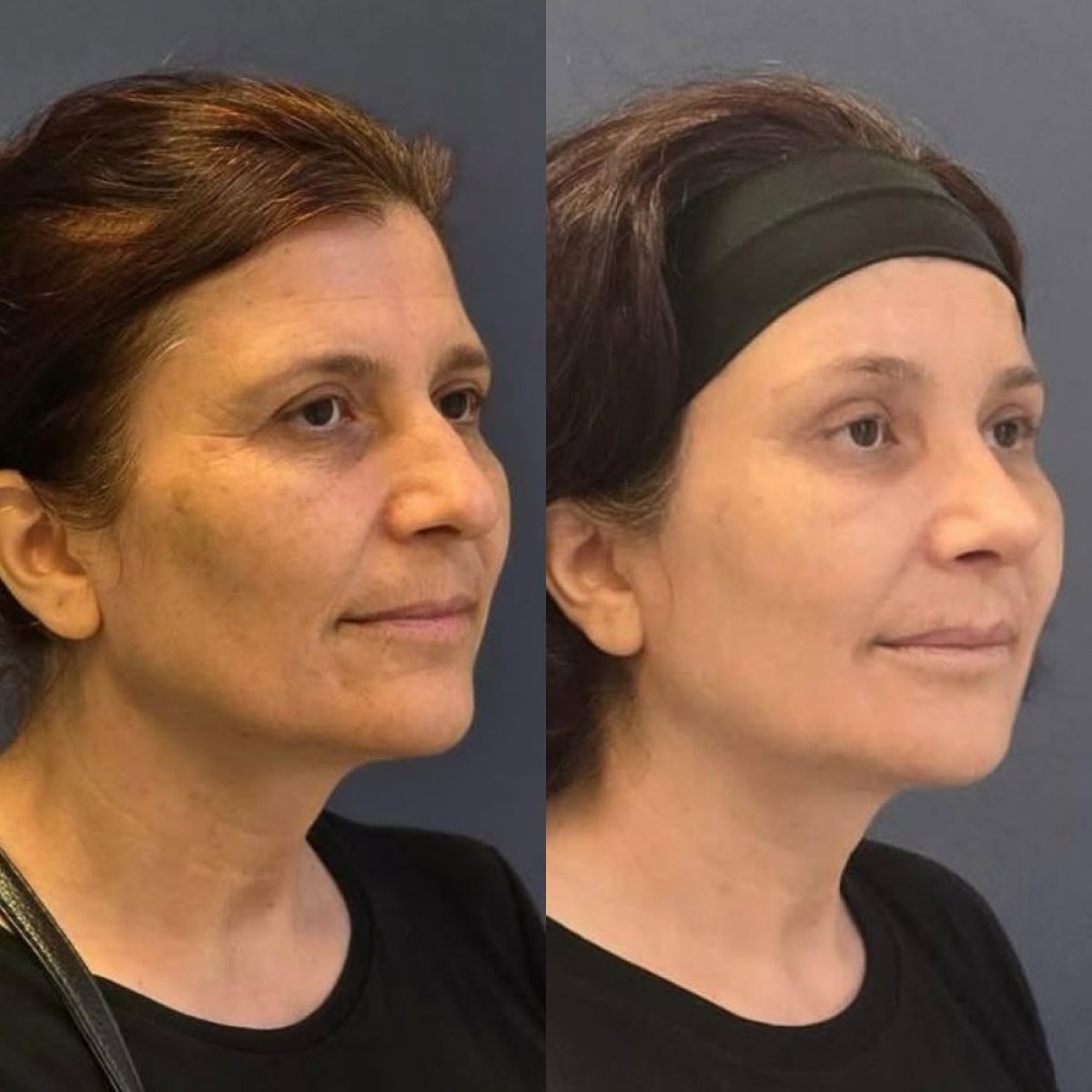 Resultados antes y después de lifting de frente en Turan Turan Health Group, rejuvenecimiento facial visible