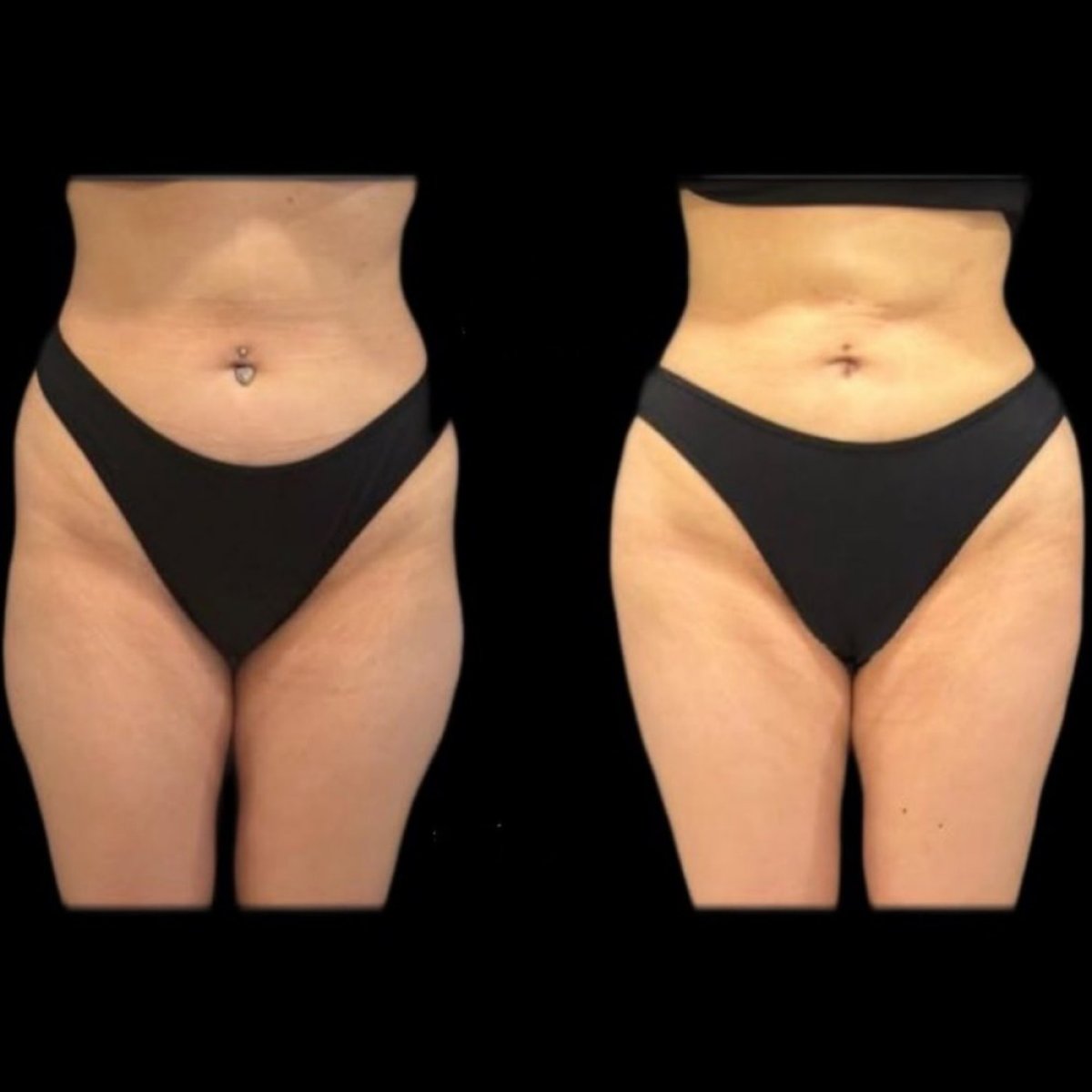 Resultados de lifting de muslos antes y después en Turan Turan Health Group, contorno mejorado