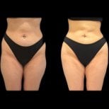 Before and after thigh lift results at Turan Turan Health Group, improved thigh contour