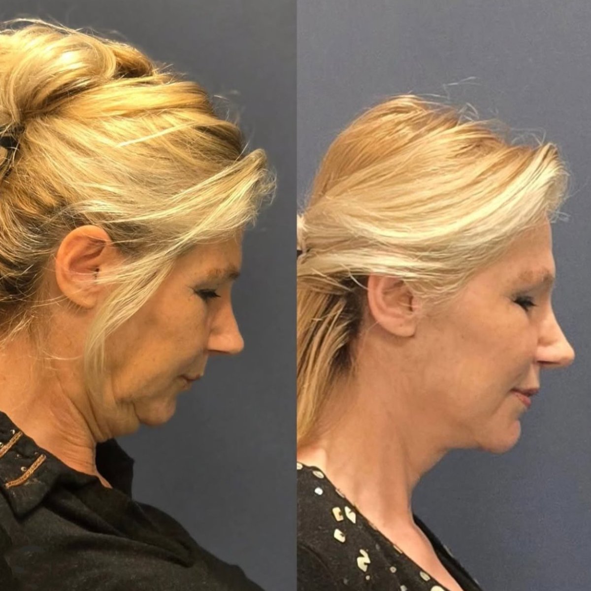 Resultados de liposucción de cuello antes y después en Turan Turan Health Group, contorno mejorado