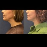 Результаты липосакции шеи до и после в Turan Turan Health Group, улучшенный контур челюсти