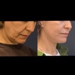Before and after neck liposuction results at Turan Turan Health Group, improved jawline contour