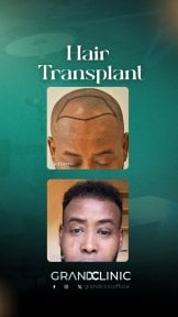 before-after photo hair-transplant